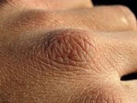 HABERİM 724|Balık pulu hastalığı nedir