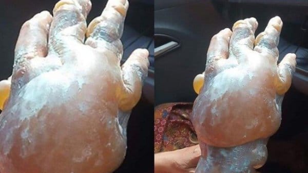 dis-macunu-yaniklara-duzgun-gelmiyor-0-AAPYKgTJ.jpg HABERİM 724 | Diş macunu yanıklara düzgün gelmiyor