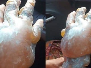 HABERİM 724 | Diş macunu yanıklara düzgün gelmiyor