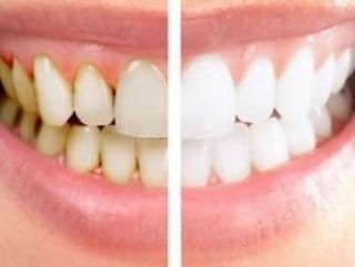 HABERİM 724 | Diş taşı nedir