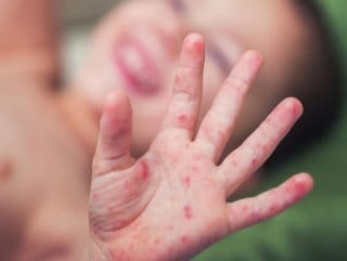 HABERİM 724 | Kızamık olayları dünya çapında dört kat arttı