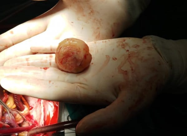 HABERİM 724 | Şanssız bayanın kalbinden kitle çıkarıldı