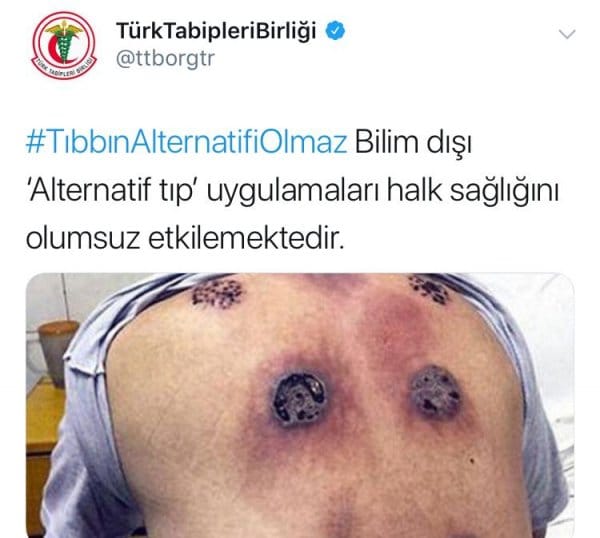 HABERİM 724 | Tabipler Birliği hacamata karşı